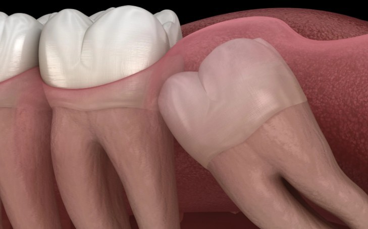 【夢占い】親知らずの夢の意味 16 選