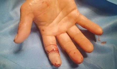 【夢占い】指が折れる夢の意味 24 選