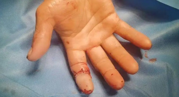 【夢占い】指が折れる夢の意味 24 選