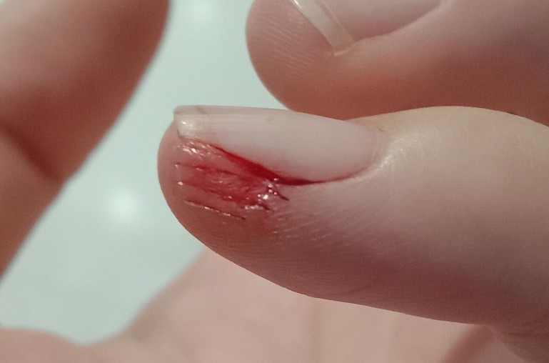 【夢占い】手を怪我する夢の意味 22 選