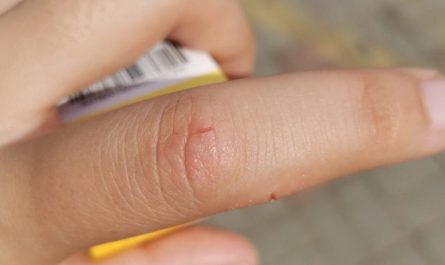 【夢占い】指を怪我する夢の意味 28 選