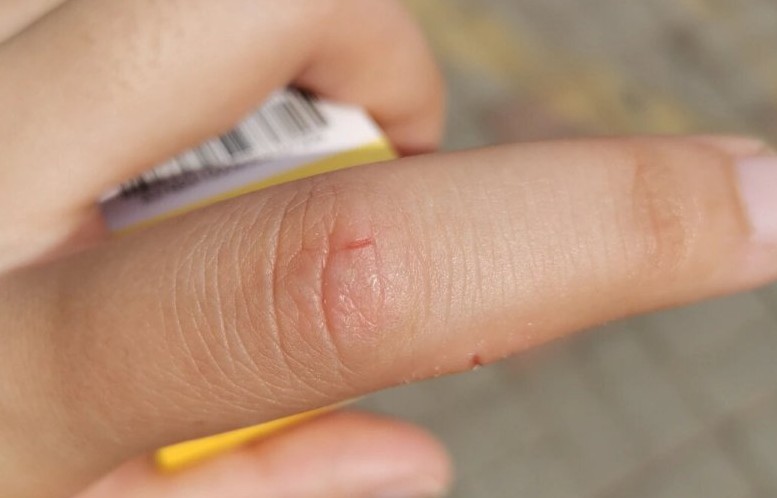 【夢占い】指を怪我する夢の意味 28 選