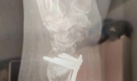 【夢占い】手首を骨折する夢の意味 16 選