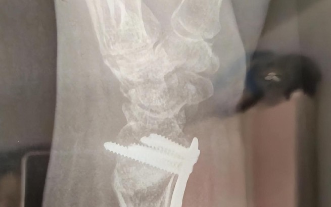 【夢占い】手首を骨折する夢の意味 16 選